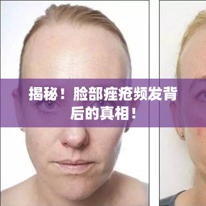 揭秘！脸部痤疮频发背后的真相！